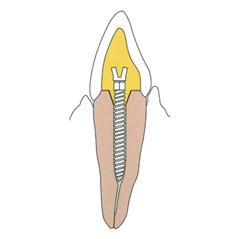 SCREWPOST RRA-EL6